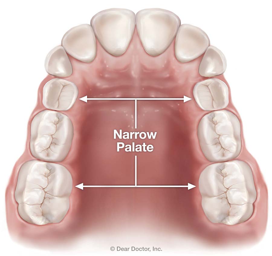 Narrow Palate Taylor Orthodontics in Tustin and Ladera Ranch, CA